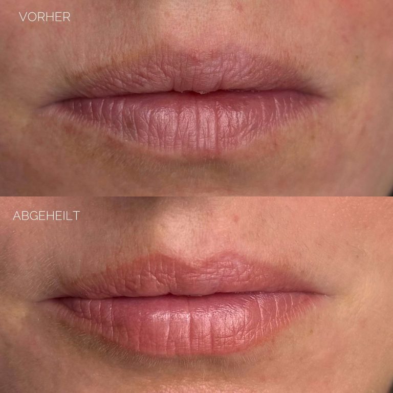 Aquarell Lips – vorher und abgeheilt
