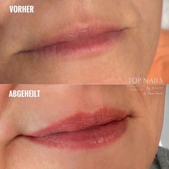 Lippen-Pigmentierung vorher und abgeheilt
